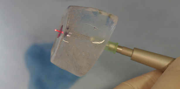 Diodenlaserunterstützte ­Kombinationstherapie eines Hämangioms