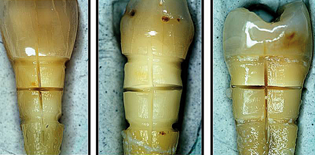 Modifikation von Zahnhalsdentin mit einem Diodenlaser