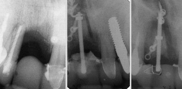 Vertikale Distraktionsosteogenese des Alveolarfortsatzes