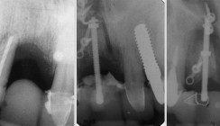 Vertikale Distraktionsosteogenese des Alveolarfortsatzes