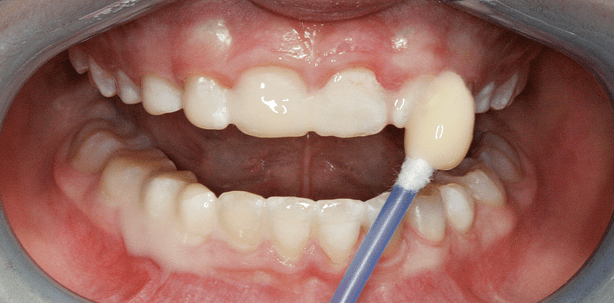 Die Kinderindividualprophylaxe