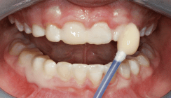 Die Kinderindividualprophylaxe