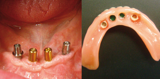 Neuer Hochleistungskunststoff in der Doppelkronentechnik