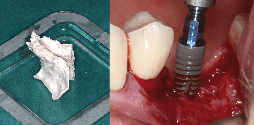 3-D-Formen zur Anpassung konfektionierter, starrer Biomaterialmembranen