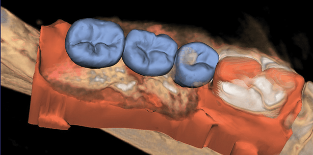 Darstellungsqualität und Strahlenbelastung bei der DVT-Diagnostik