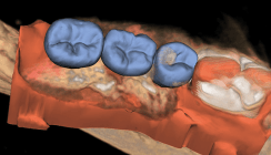 Darstellungsqualität und Strahlenbelastung bei der DVT-Diagnostik