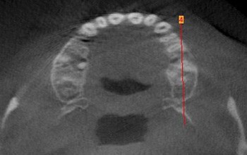 DVT bei der Parodontitis-Diagnostik