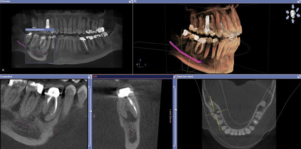 Sichere Therapieplanung im zahnärztlichen Alltag dank 3-D-Diagnostik