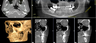 DVT – Indikationen und Strahlenbelastung