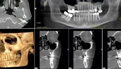 DVT – Indikationen und Strahlenbelastung