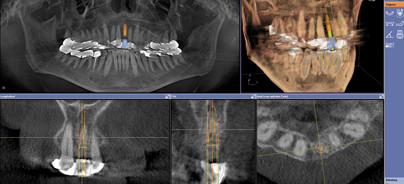 Moderne Implantatplanung integriert CAD/CAM und DVT