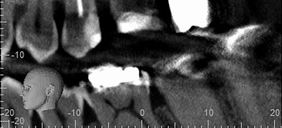 DVT in der Endodontie – Sinn oder Unsinn?