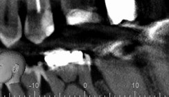 DVT in der Endodontie – Sinn oder Unsinn?