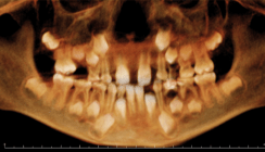 DVT in der Kieferorthopädie – wo stehen wir?