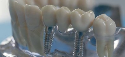 Periimplantitis: „Der Patient muss über das Problem aufgeklärt werden“