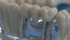 Periimplantitis: „Der Patient muss über das Problem aufgeklärt werden“