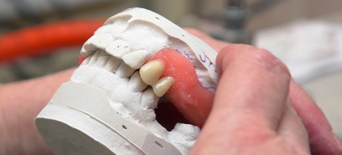 Neue Studie belegt: Import von Zahnersatz nimmt zu - Dentaltourismus bleibt Randerscheinung