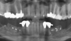 Planungsstrategien bei interdisziplinären Behandlungen in der Oralchirurgie