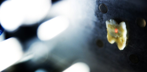 Laser-Prototyp soll schmerzarme Kariesbehandlung ermöglichen