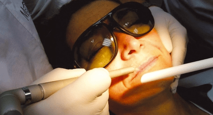 Neue Dentallaser: Zähne schön und Falten passé