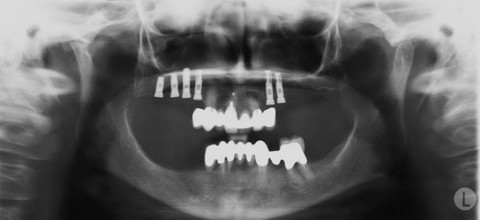 Kausale implantologisch-prothetische Sanierung
