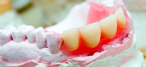 Kostenvoranschlag auch für Zahnersatz aus Ausland