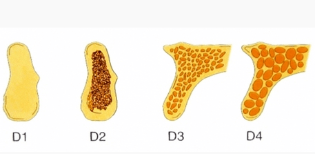 Die Osteodensitometrie mittels DVT