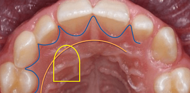 Chirurgische Behandlung der Eckzahndystopie
