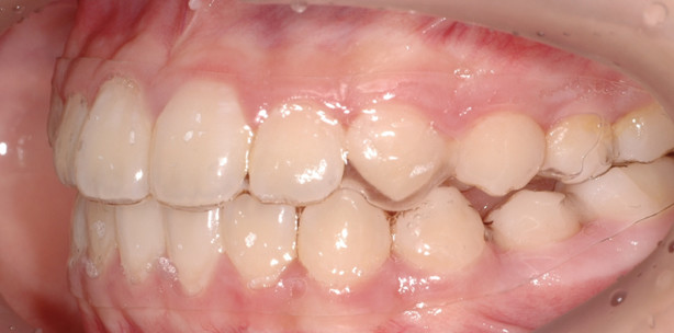 Die eCligner®-Behandlung beim jugendlichen Patienten