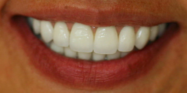 4-Quadranten-Rehabilitation mit festsitzenden implantatgetragenen Brücken