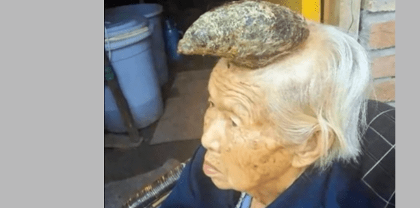 Chinesin wächst zwölf Zentimeter langes Horn aus dem Kopf