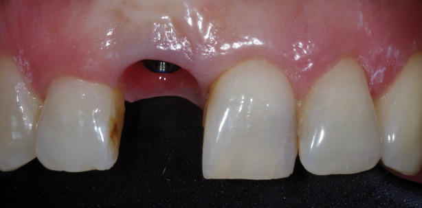 Prothetische vollkeramische Einzelzahnimplantatversorgung in der ästhetischen Zone