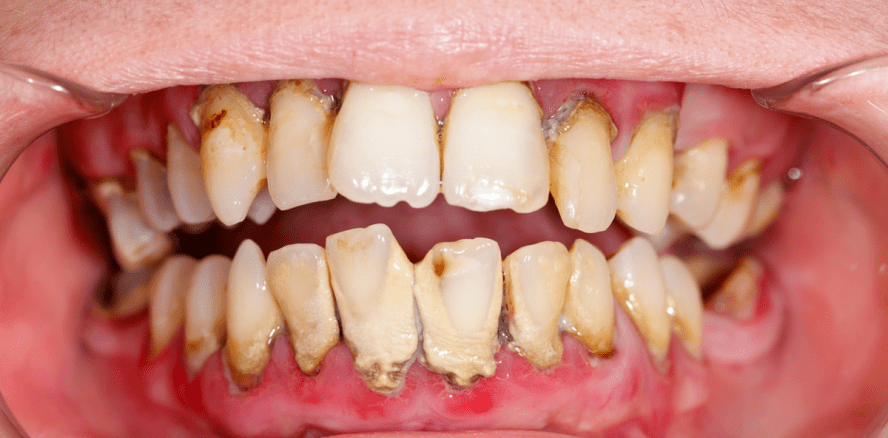 Ekel-Zähne als Beweismittel vor Gericht