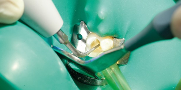 Effektives Präparieren mit geringem Fehlerrisiko