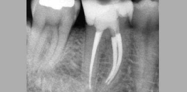 Modernste Endodontie mit einem einfachen Konzept