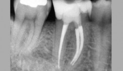 Modernste Endodontie mit einem einfachen Konzept
