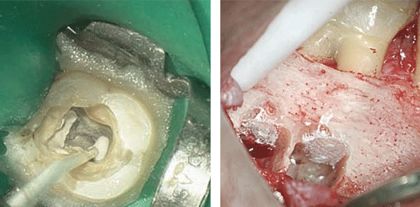 Die wegweisende biokeramische Obturations-Technologie