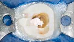 Die postendodontische Versorgung