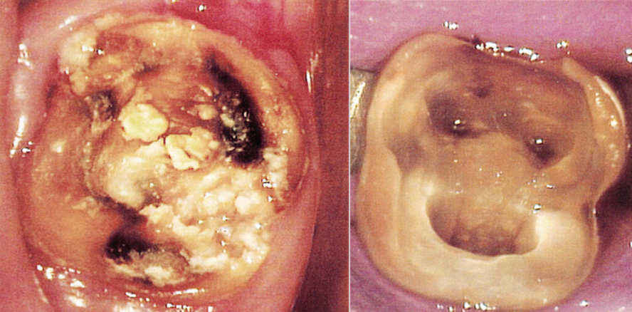 Tief zerstörte Zähne erhalten