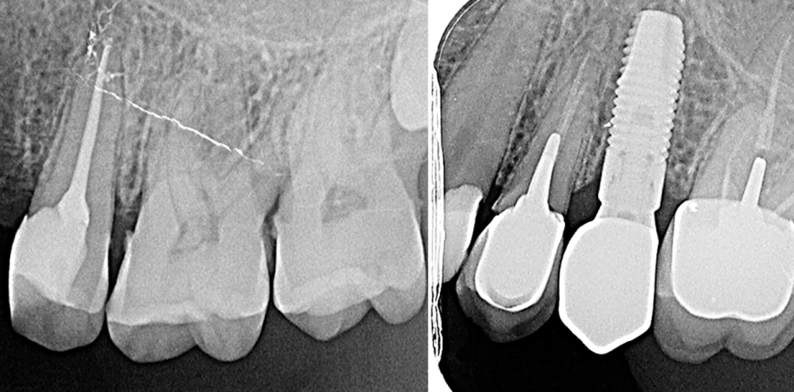 Endodontie versus Implantologie – Wird die Wurzelkanalbehandlung überflüssig?