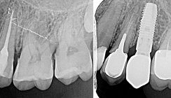 Endodontie versus Implantologie – Wird die Wurzelkanalbehandlung überflüssig?