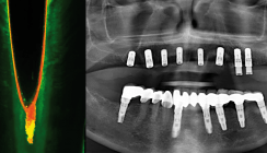 Endodontie vs. Implantologie