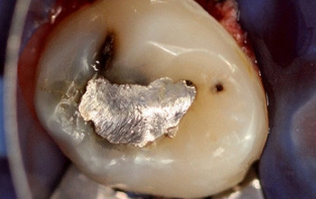 Konservierende Restaurationen im Milchgebiss