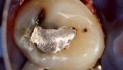 Konservierende Restaurationen im Milchgebiss