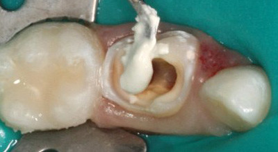 Die Pulpotomie in der Milchzahnendodontie