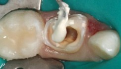 Die Pulpotomie in der Milchzahnendodontie