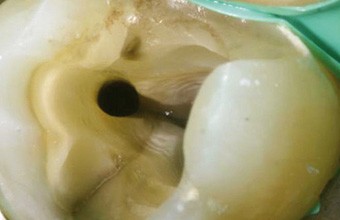 Endodontische Revisionen mit System
