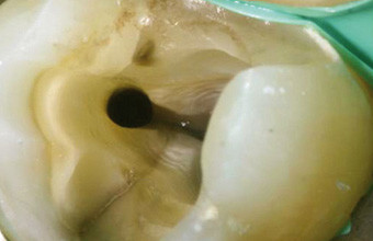 Endodontische Revisionen mit System