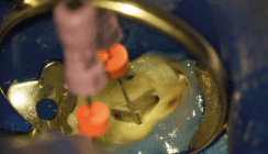 Wurzelkanalaufbereitung – ein notwendiger und komplexer Schritt