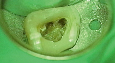 Die orthograde Revision - eine Falldarstellung